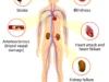 Ilustrasi Komplikasi Penyakit Kolesterol captured via Medlite Pharmacy