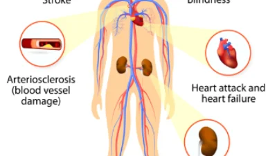 Ilustrasi Komplikasi Penyakit Kolesterol captured via Medlite Pharmacy