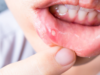 Penyebab Sariawan, Luka Kecil dengan Rasa Sakit yang Serius (Sumber foto: Redmires Dental Care)