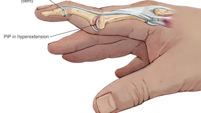 Cari Tahu Tentang Deformatis Leher Angsa yang Terjadi Pada Jari Tangan (Image From: Lex Medicus Pathologies)