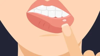 Hempaskan Si Perih: 5 Cara Alami Mengatasi Sariawan, Ampuh Banget! Sumber Ilustrasi via Teeth Talk Girl