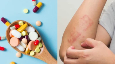 Alergi Obat Kenali Penyebab, Faktor Risiko, Gejala, dan Penanganannya