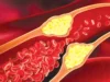 Mengungkap Dampak Kolesterol dan Solusi Inovatif untuk Kesehatan Pembuluh Darah Anda!