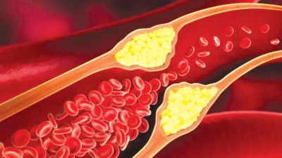 Mengungkap Dampak Kolesterol dan Solusi Inovatif untuk Kesehatan Pembuluh Darah Anda!