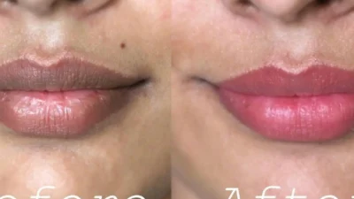 Cara Menghilangkan Bibir Hitam dan Cara Mengembalikan Warna Asli