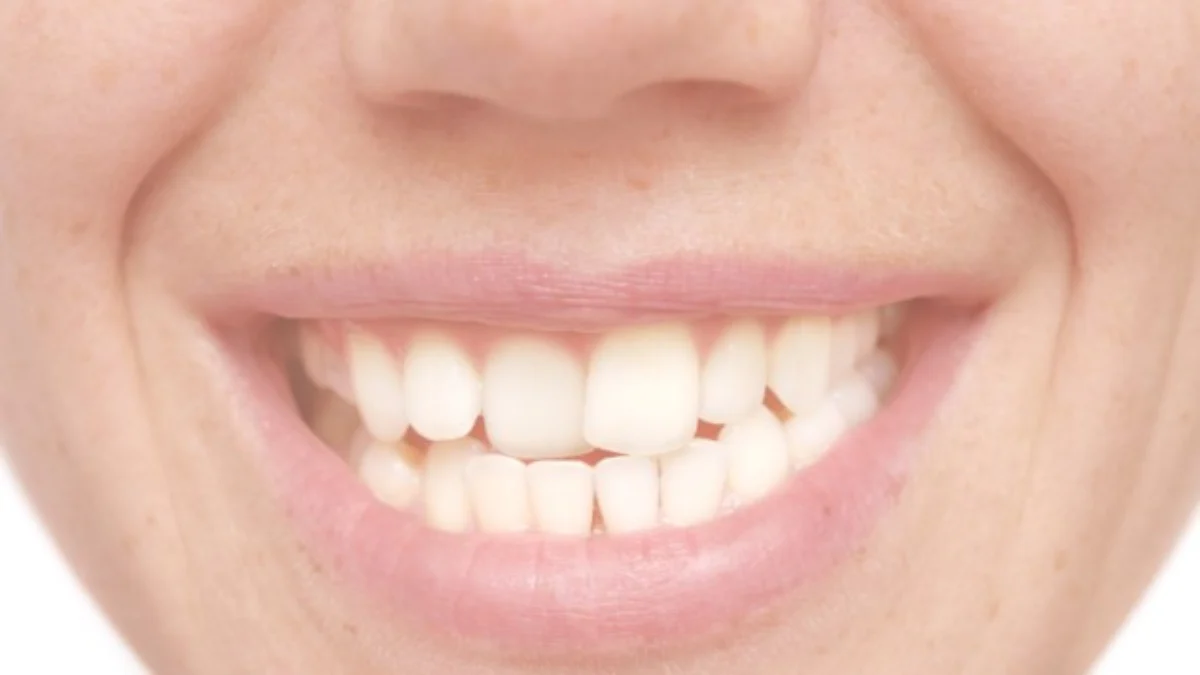 7 Jenis Perawatan Gigi yang Ditanggung BPJS. (Sumber Gambar: Golden State Desntistry)