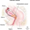 5 Ciri-ciri Kanker Sarkoma Rahim. (Sumber Gambar: Cleveland Clinic)